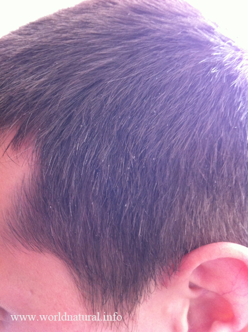 шампунь от перхоти шампунь от перхоти