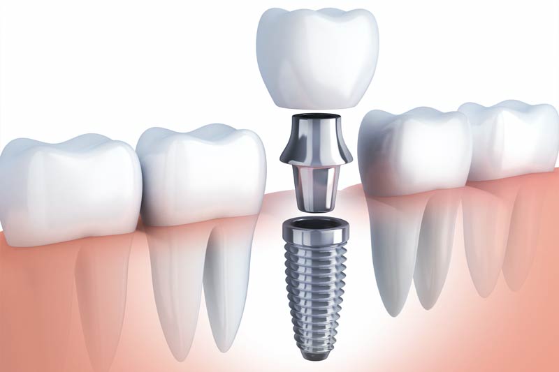 Emergency Dentist in San Bernardino
